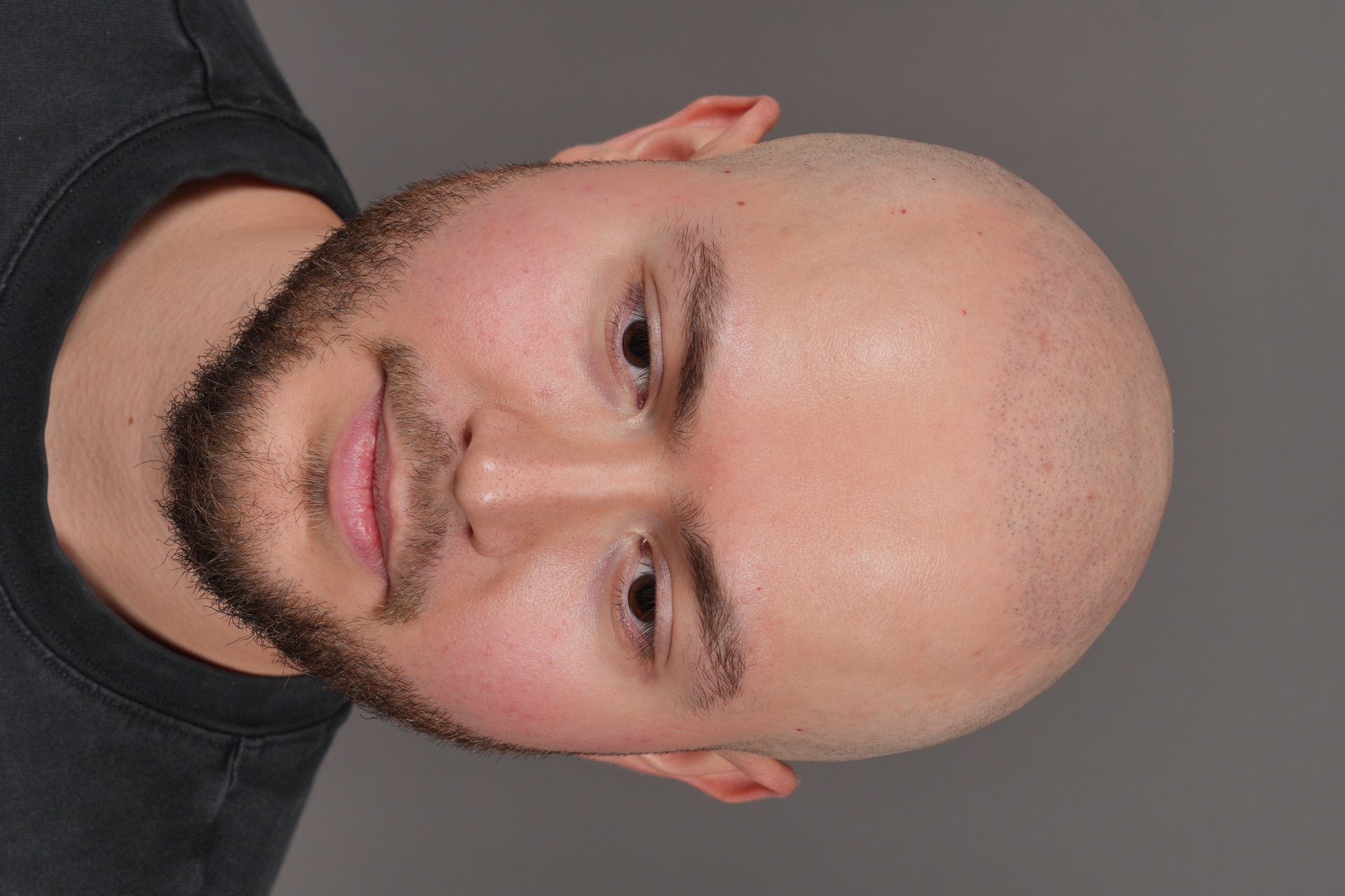 SMP hairline, frontal view